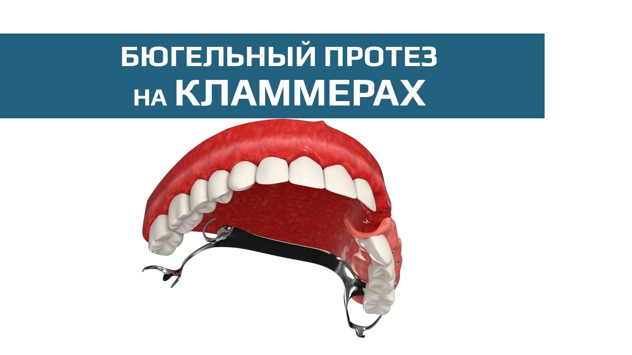 Бюгельные протезы: бюгельный протез на кламмерах - YouTube