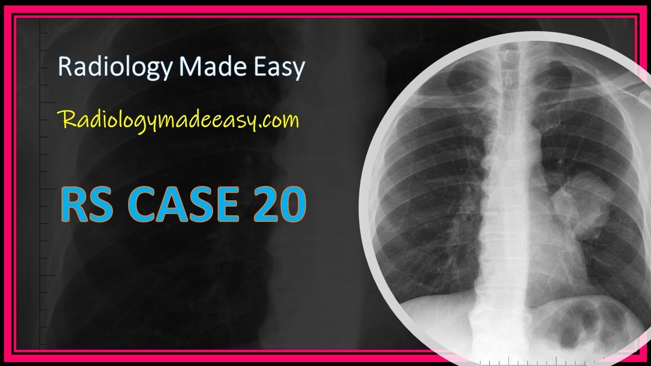FRCR Radiology RS cases 20 52 yrs old smoker presented with