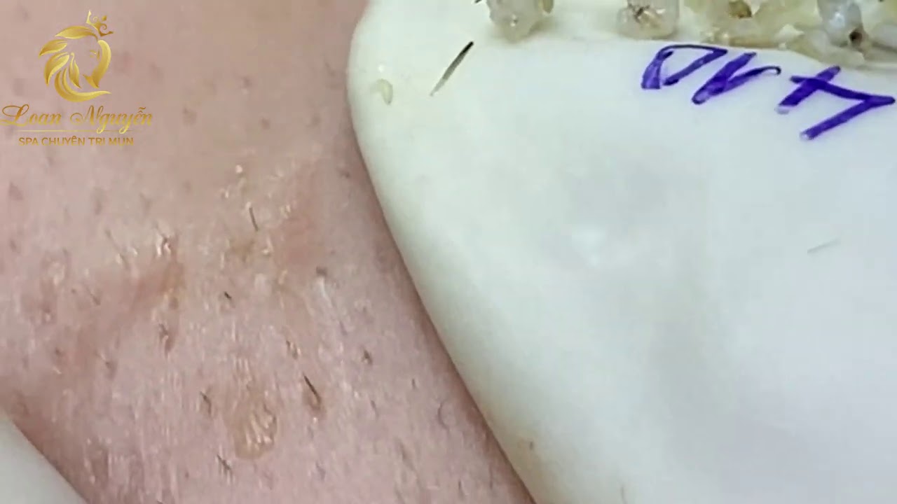 Blackheads and Whiteheads extraction (410) | Loan Nguyen