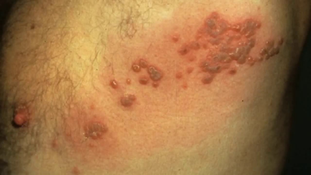 ជំងឺអ៊ប៉េសស៊ោះសស្ទ័រ Herpes Zoster 带 状 疱 疹 