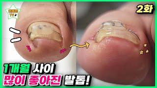 (eng sub)[2편]1개월 사이 많이 좋아진 발톱!｜레푸스 서면점/사상점｜ingrown toenail｜Athlete&#39;s foot-Fresh Foot