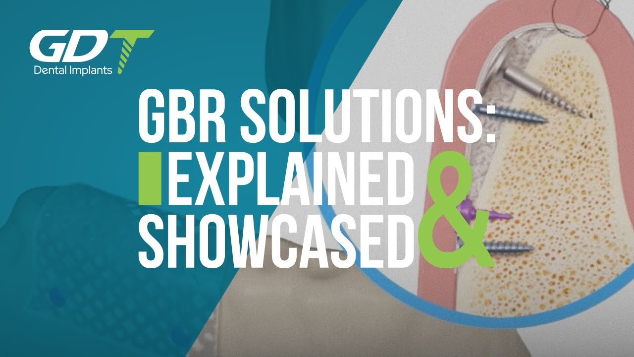 GDT Implants Guided Bone Regeneration GBR Solutions: Explanation and Product Showcase