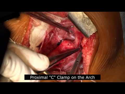 Surgical Repair for Coarctation of the Aorta