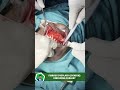 Fibrous Dysplasia (Benign) Debulking Surgery