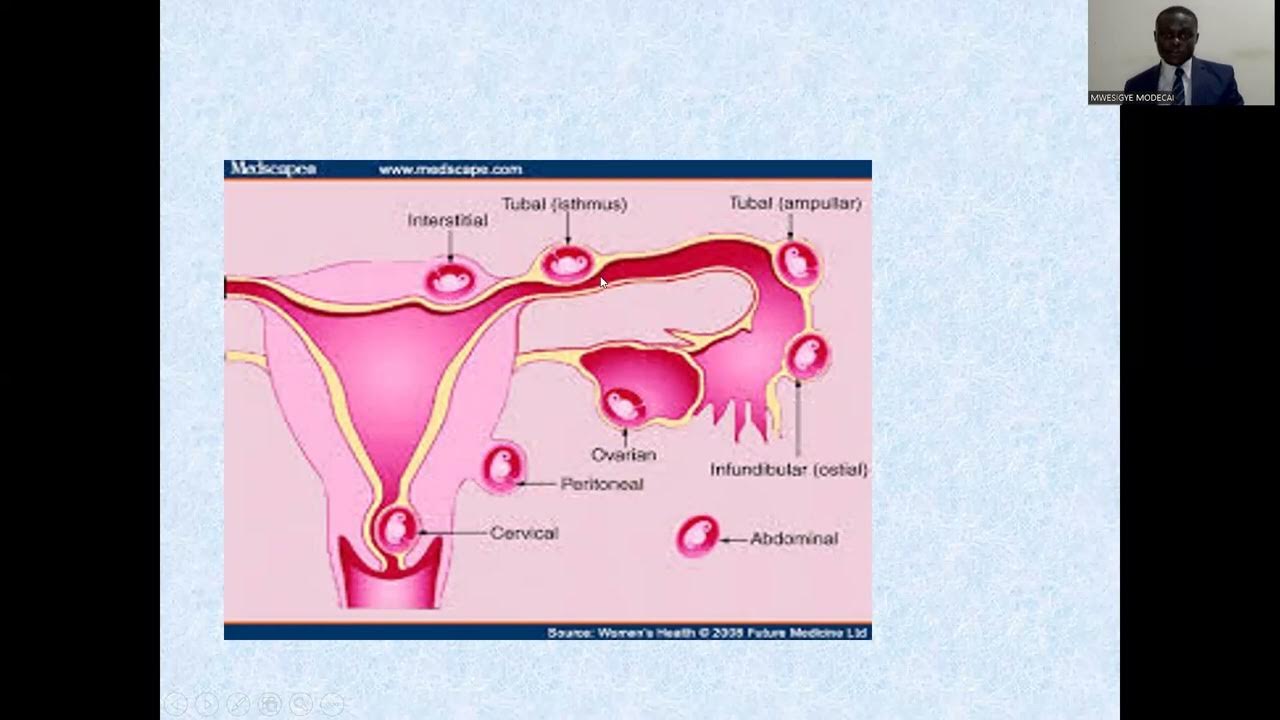 ECTOPIC PREGNANCY YouTube