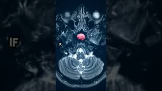 Debunking the 10% Brain Myth! Debunking the 10% Brain Myth!