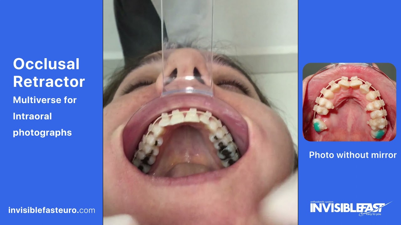 Occlusal Retractor