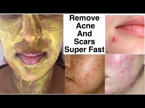 How to REMOVE ACNE AND ACNE SCARS SUPER FAST | INDIAN HOME REMEDY | Get FAIR SKIN and BRIGHT SKIN