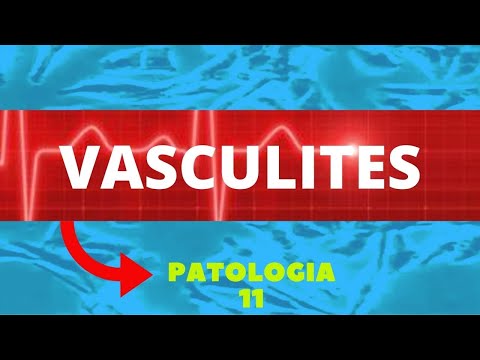 Vídeo: Vasculite Retiniana Com Osteomielite Multifocal Recorrente Crônica: Relato De Caso E Revisão Da Literatura