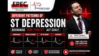 ECG Tips: ST Depression ECG Patterns Explained: What Every Clinician Must Recognise