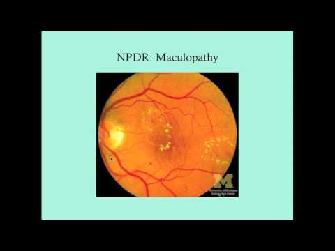 Diabetic Retinopathy - CRASH! Medical Review Series