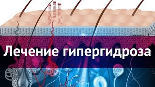 Лечение повышенной потливости