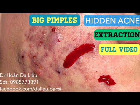 Nặn mụn nhọt mủ, mụn áp xe, mụn ẩn ở mặt| Squeeze super big pimples on the face 0985773391 NVX full