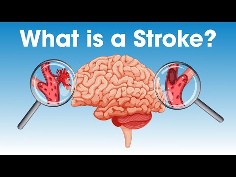 What Happens During a Stroke | Munson Minutes