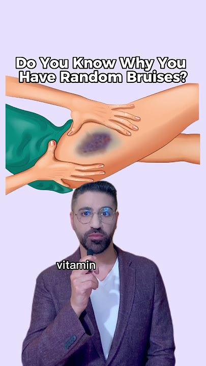 Do you know why you get random bruises?