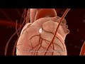 Percutaneous coronary intervention pci