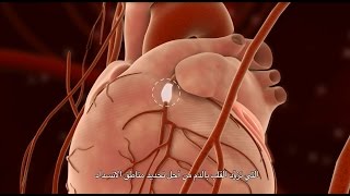 Percutaneous Coronary Intervention (PCI)