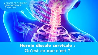 Hernie discale cervicale - Symptômes, causes et traitements