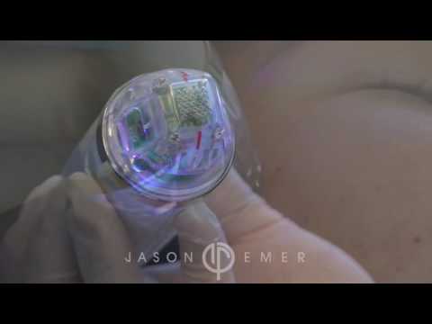 Intensif RF Micro Needling | Bellafill Injection for Acne Scar Treatment | Dr. Jason Emer