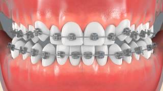 Braces for Crowded Teeth (Center View)