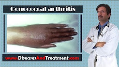 Gonococcal arthritis : Causes, Diagnosis, Symptoms, Treatment, Prognosis