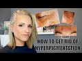 HOW TO GET RID OF HYPERPIGMENTATION - AGE SPOTS, SUN SPOTS, MELASMA, ACNE SCARS