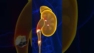 Sỏi Thận Khi Nào Cần Phẫu Thuật