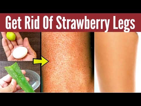 How to Get Rid of Strawberry Legs Fast | Strawberry Legs Home Remedies ...