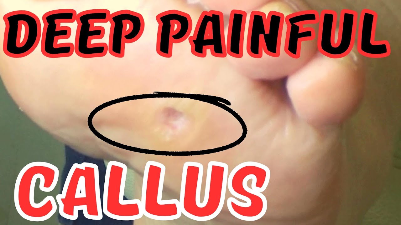 Deep painful foot callus treatment. YouTube