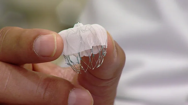 Local doctors using "Watchman" device to reduce stroke risk