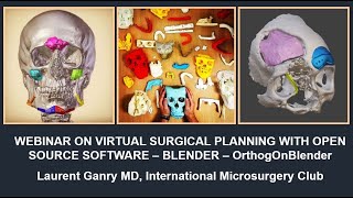 Open source Virtual Surgical Planning, Maxillofacial Head & neck surgery (OrthogOnBlender / Blender) screenshot 3