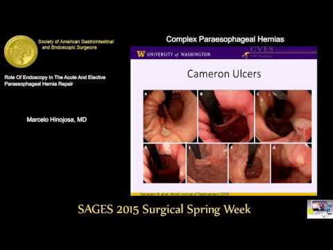 Barium Swallow Vs Endoscopy