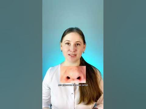 Черные точки, сальные нити - YouTube