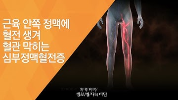 근육 안쪽 정맥에 혈전 생겨 혈관 막히는 심부정맥혈전증 - (2009.10.22_444회 방송)_붓고 무겁고 아픈 다리, 정맥질환