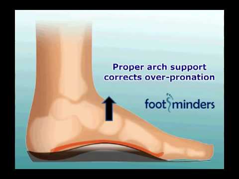 Foot Pain Due to Flat Feet and Over-Pronation: An Easy Solution