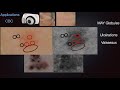 Uv induced fluorescence dermosocpy and sub uv reflectance dermoscopy