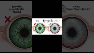 # "Topical steroids are absolutely contraindicated in epithelial herpes simplex keratitis"