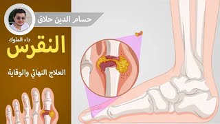 النقرس أو إرتفاع حمض اليوريك - أعراضه و اسبابه وعلاجه بالتغذية ومن الصيدلية