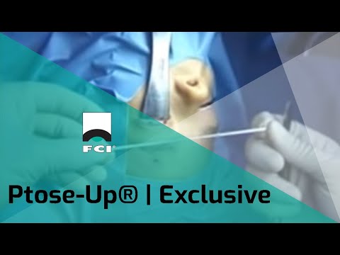 Ptose-Up® | ePTFE Frontalis Suspension | Features & Procedure | Exclusive | FCI Eyelids