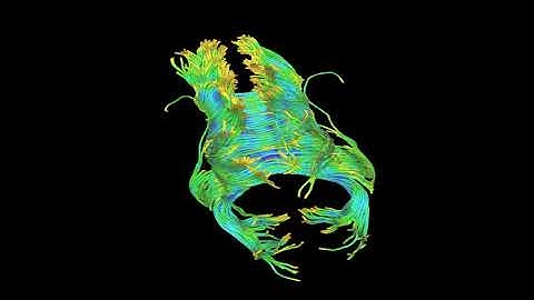 Corpus Callosum White Matter Tracts Animation DTI