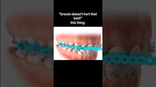 Top 5 Most Painful Things About Braces! 😭🦷