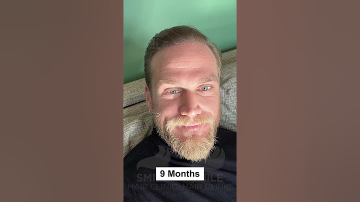 MONTH BY MONTH HAIR TRANSPLANT RESULT - BEFORE AND AFTER