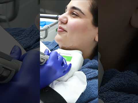Bye Double Chin! Real CoolSculpting Results #Shorts