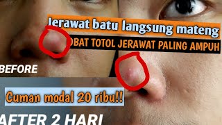 Menghilangkan Komedo Hitam di hidung | Komedo Hidung | Membersihkan Jerawat Parah | Jerawat batu