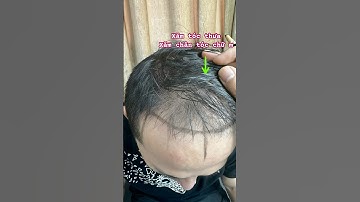 Hói đầu, tóc thưa ngay lập tức biến mất nhờ xăm chân tóc #reviewxămtóc
