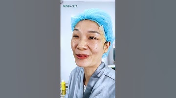 Kết quả bất ngờ sau 60 phút căng da nội soi Smas