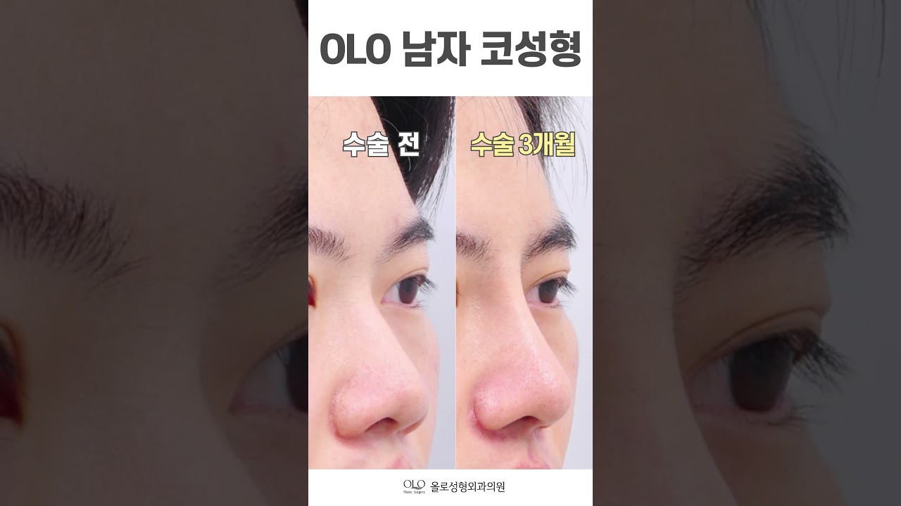 [ОЛО гоо сайхны мэс заслын эмнэлэг] #эрэгтэйхамаргоосайхнымэсзасал Яг ингэж л хий, ОЛО-д хамраа дээд зэргээр #өндөрсгөх #шортс