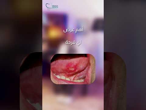 سرطان الفم