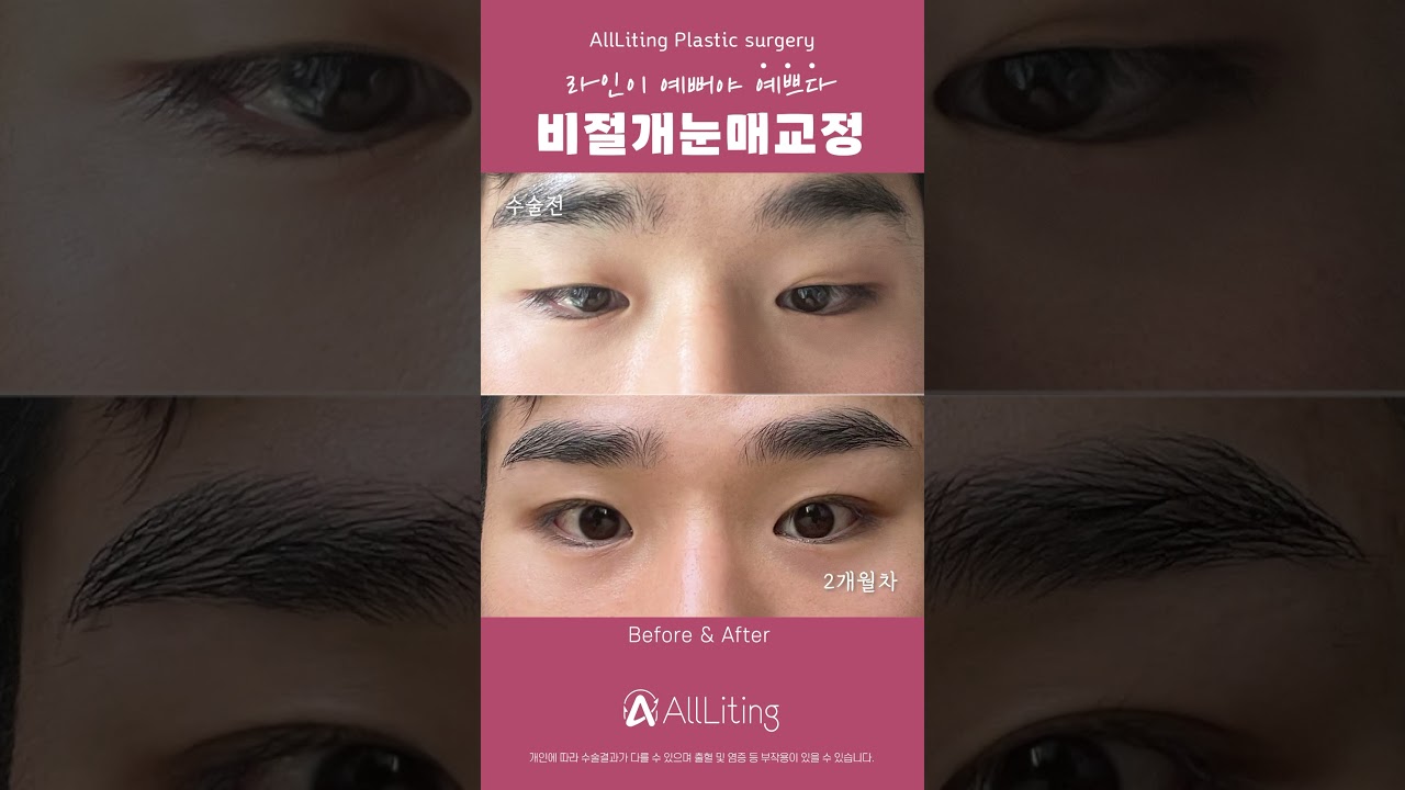 [Olliting整形外科診所] 自然又分明有神的 #男性眼型矯正 就在 #Olliting ⭐️ 透過 #非切開眼型矯正 僅需一週即可見證帥氣迷人的蛻變🥰 #結膜炎 #過度矯正 #外眼角固定 #三白眼 #江南 #江南整形外科