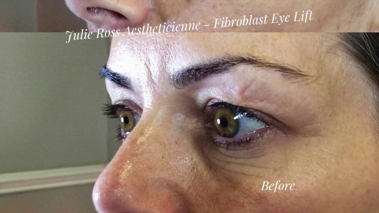 Fibroblast Eye Lift Explained, All you need to know